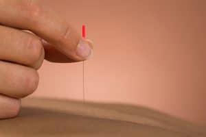 Modern Medical Acupuncture