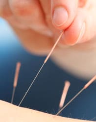 Acupuncture, Tui Na, Fertility, Cupping, Needling