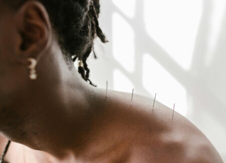 Dry Needling at Feel Good Balham